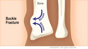 Buckle fracture