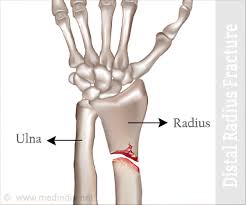 Distal radius fracture