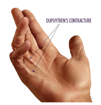 dupuytren hand