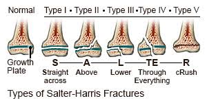 Salter Harris chart