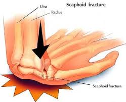 Scaphoid fracture