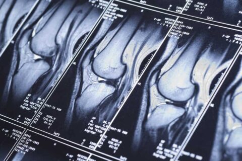 Knee MRI